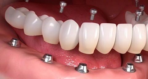 All on 5 Implants with Acrylic Fixed Set of teeth 
