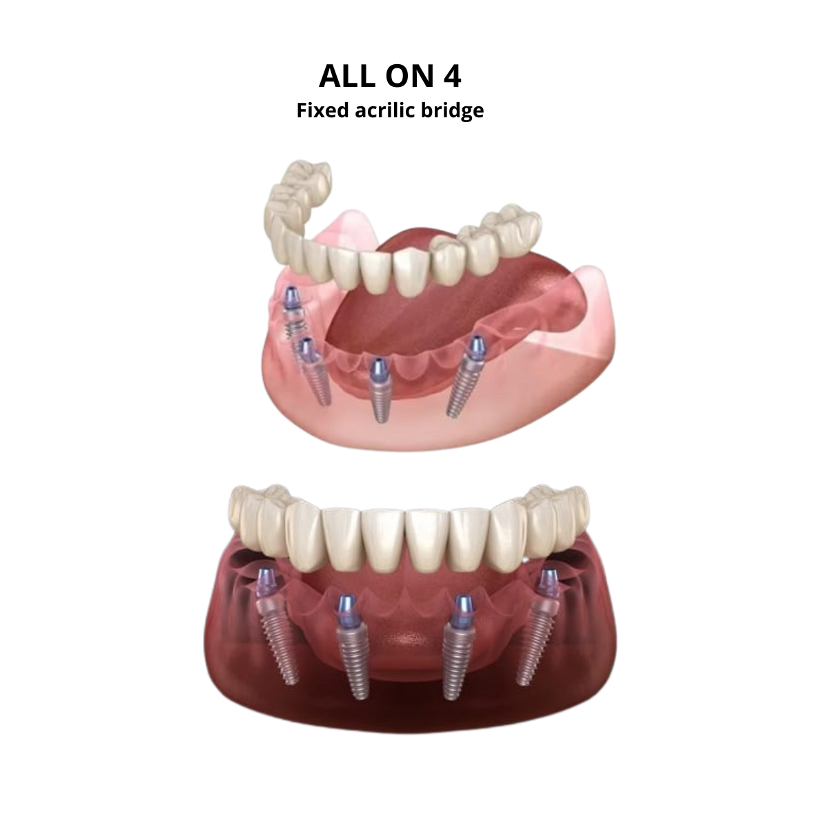 All on 4 with fixed acrilic bridge